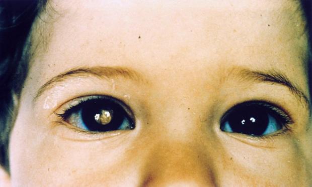 Пухлина сітківки ока розвивається найчастіше в дитячому віці. Фото: xn ---- 7sbbpetaslhhcmbq0c8czid.xn--p1ai