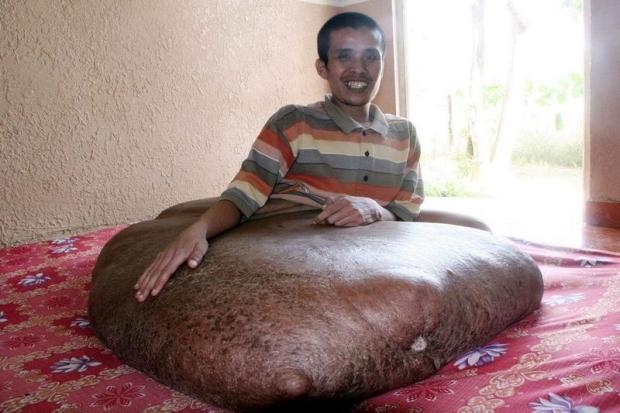 В'єтнамцеві видалили 90-кілограмову пухлину на нозі. Фото: Рекорди і факти.