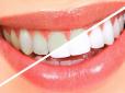 Лайфхак: Стоматолог розповів, як усунути зубний камінь і відбілити зуби за 4 хвилини