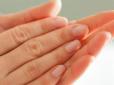 Діагноз за руками, або Що нігті можуть розказати про стан здоров'я