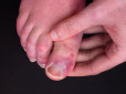 Коронавірус може вражати пальці ніг: Лікарі показали фото і розповіли про небезпечні симптоми