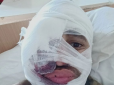 Накрили касетними бомбами: Український актор показав, як сильно його поранили на передовій (фото)