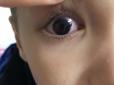 У Рівному 5-річний хлопчик встромив собі в око манікюрні ножиці: Як лікарям вдалося його врятувати (фото)