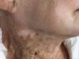 Жінка, яка 40 років носила сонцезахисний крем лише на обличчі, шокувала виглядом шиї (фото)