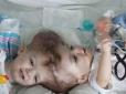 У США провели унікальну операцію з роз'єднання близнюків, що зрослися голівками (фото)