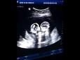 У мережі показали захоплююче відео бійки близнюків в утробі матері