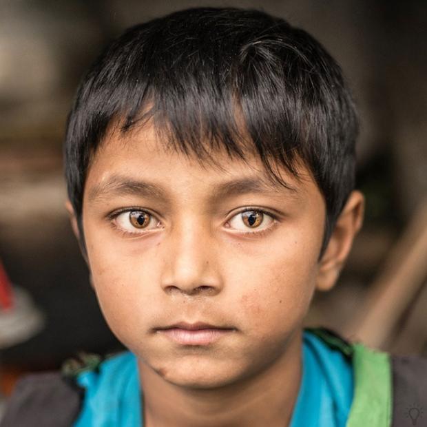У цієї дитини з Непалу - "синдром котячого ока"