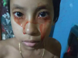 Через рідкісну хворобу дівчинка почала плакати кров'ю (фото)