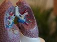 Чому рентген не показує ураження легень при коронавірусі: Вчені дали чітку відповідь