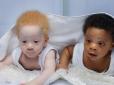 З архіву ПУ. Справнє диво: Дівчина народила близнюків з різним кольором шкіри. Тепер їй не вірять, що обидві дитини її (фото)