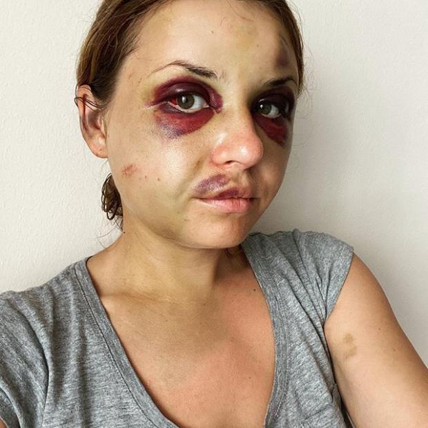 Анастасія Лугова після нападу