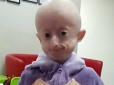 У Вінниці померла єдина в Україні дитина з синдромом передчасного старіння (фото, відео)