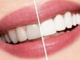Збережіть чарівність посмішки: Які продукти зіпсують зуби