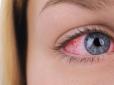 Сприяє температура і вологість: У країнах Азії масштабний спалах хвороби, що вражає очі