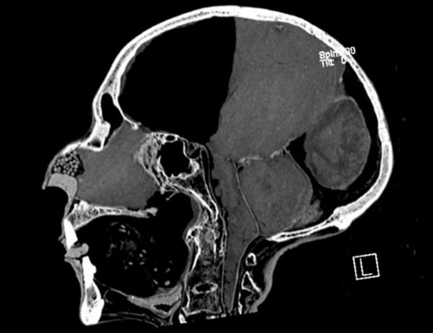 Зображення комп'ютерної томографії голови мумії