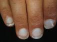 Не пропустіть сигнал! Хвороби, які можна розпізнати за станом нігтів
