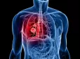 Оце так! Добавки вітаміну А пов’язані з раком легень